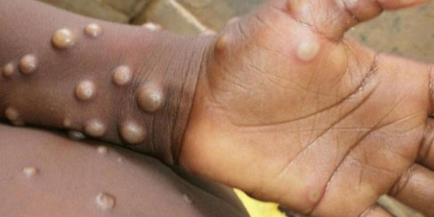 Maymun çiçeği alarmı! Kıta genelinde acil durum ilan edildi