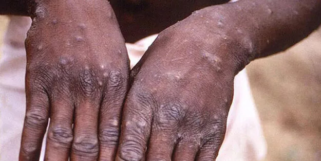 Maymun çiçeği hastalığı belirtilerine dikkat! Bu yaş grubu tehlike altında!