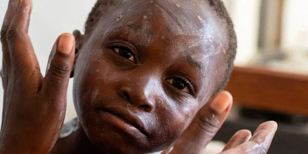 Maymun çiçeği hastalığı nedir, nasıl bulaşır? Afrika Birliği: Maymun çiçeği virüsü tüm dünyanın sorunu