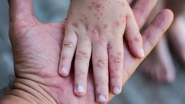 Maymun çiçeği hastalığının belirtileri nelerdir? Maymun çiçeği nasıl anlaşılır?