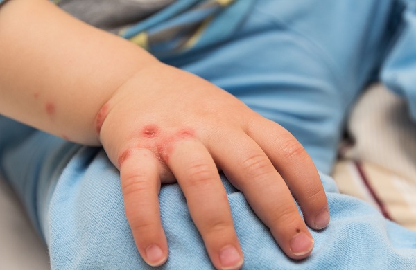 Maymun çiçeği için PCR mı alınıyor? Maymun çiçeği tanısı nasıl konur?