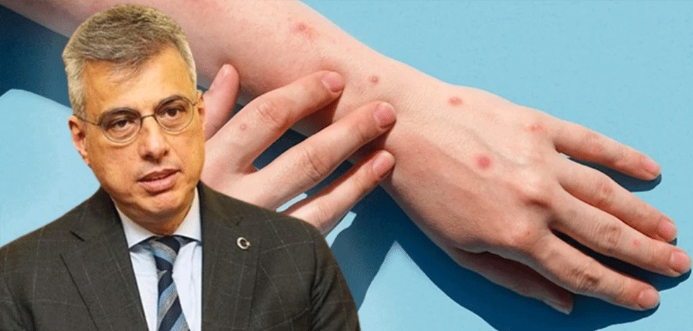 Maymun Çiçeği Türkiye'de görüldü mü? Sağlık Bakanı açıkladı