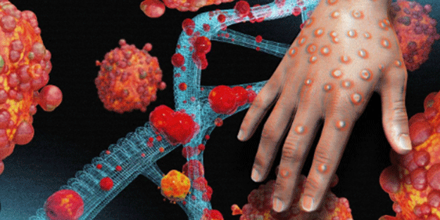 Maymun çiçeği virüsü bakın nasıl bulaşıyormuş! 30 dakika biriyle aynı odada...