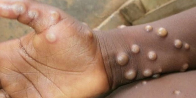 Maymun çiçeği virüsü hakkında açıklama! Bunlara dikkat