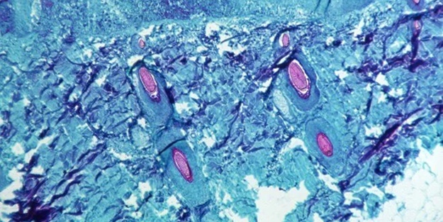 Maymun Çiçeği virüsü iki ülkeye daha sıçradı