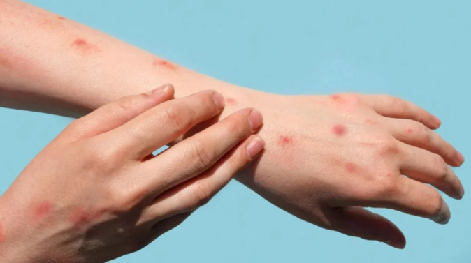 Maymun çiçeği virüsü İsveç'te görüldü