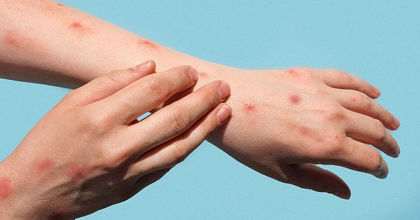 Maymun çiçeği virüsü nedir?