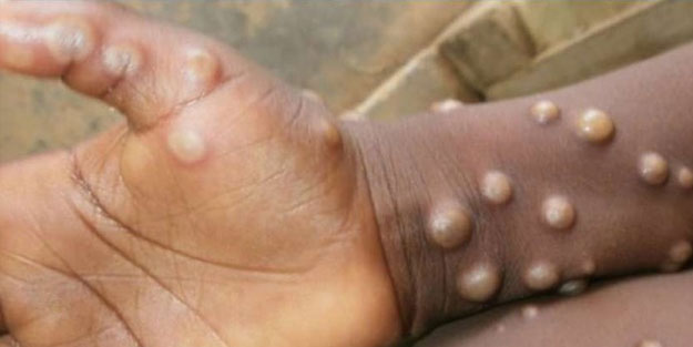 Maymun çiçeği virüsü Türkiye'de görüldü mü? Maymun çiçeği virüsü nasıl bulaşır, belirtileri neler?