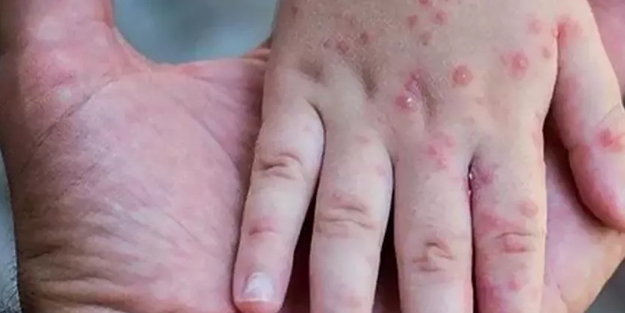 Maymun çiçeği virüsünde deri döküntüsü ve kas ağrıları görülüyor