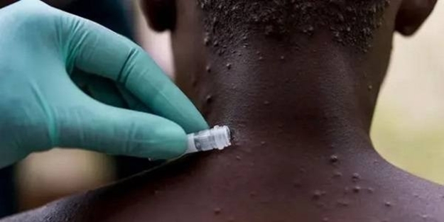 Maymun çiçeği virüsünde endişelendiren olay!