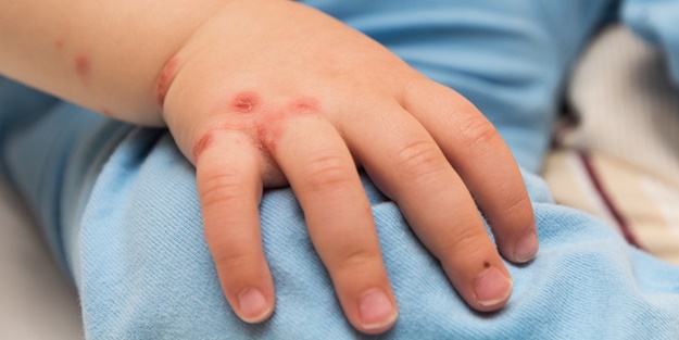 Maymun çiçeği virüsünde heyecanlandıran açıklama