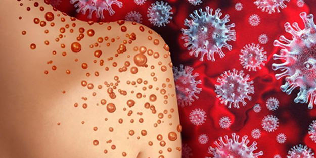 Maymun çiçeği virüsünün ilk çıktığı ülkede vaka sayısı hızla artıyor