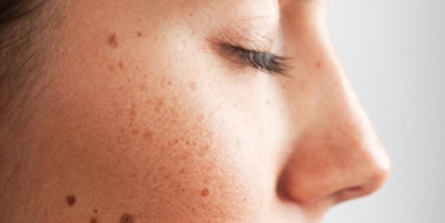 Melanom kanserini biliyor musunuz? Kimler risk altında?