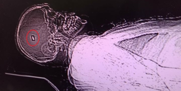 Merminin balistik incelenmesinin yapılması için kafasından çıkarılması gerek