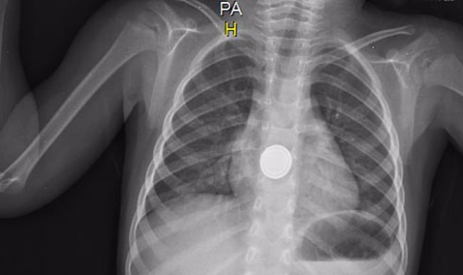 Mersin'de çocuğun yuttuğu pil yemek borusunu yaktı