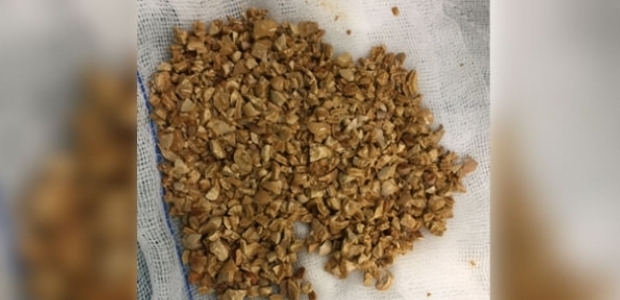 Mesanesinden 1 kilo taş çıktı