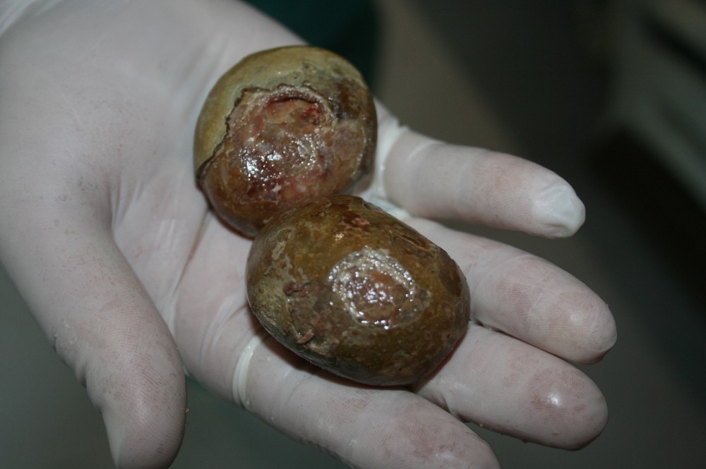 Mesanesinden yumurta büyüklüğünde taşlar çıktı 