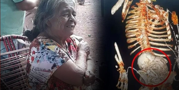 Mide ağrılarının sebebi karnındaki 56 yıllık bebek çıktı!