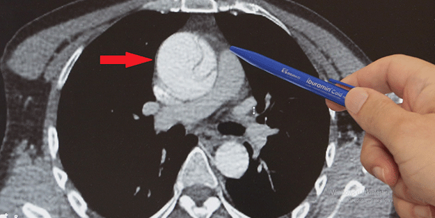 Mide ağrısı deyip geçmeyin! Az kalsın ölüyordu