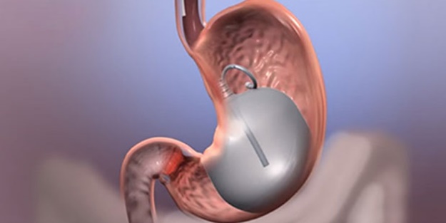 ‘Mide balonu ile hızlı kilo vermek mümkün’