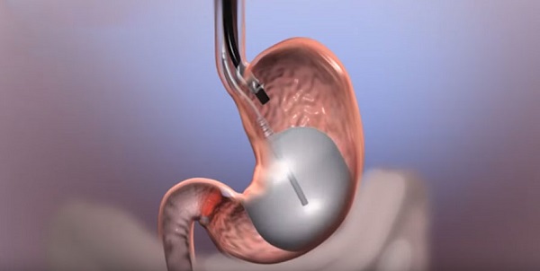 Mide balonu nedir? Mide balonu nasıl uygulanır?