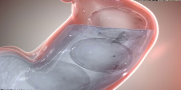 Mide içi balon kimlere uygulanır, kimlere uygulanmaz?