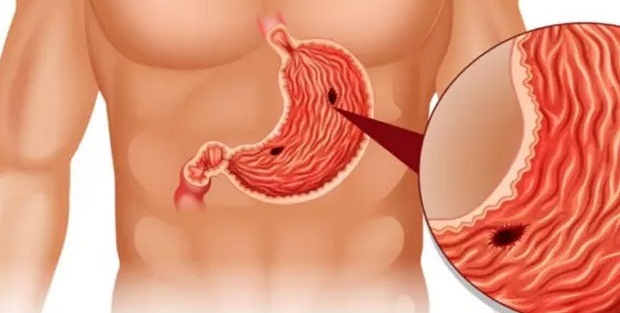 Midemizin illeti ülserin belirtileri nelerdir