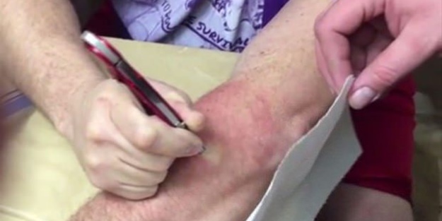 Mideniz kaldırmayabilir! Kolundaki kisti kendi çıkardı!