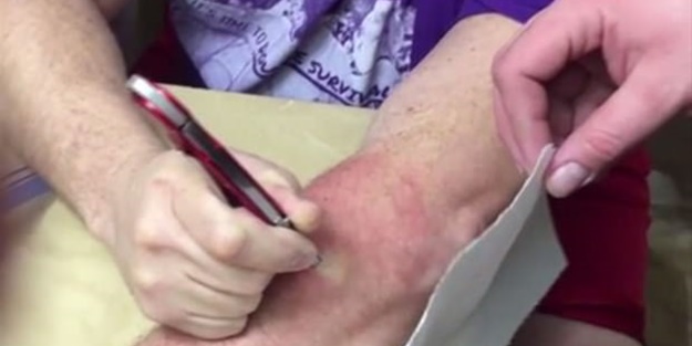  Kolundaki kisti kendisi çıkardı!