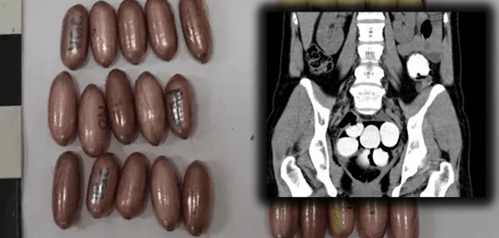 Midesinde bin 429 gram kokainle yakalandı