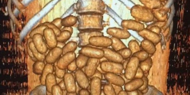 Midesinden 70 gr eroin çıktı