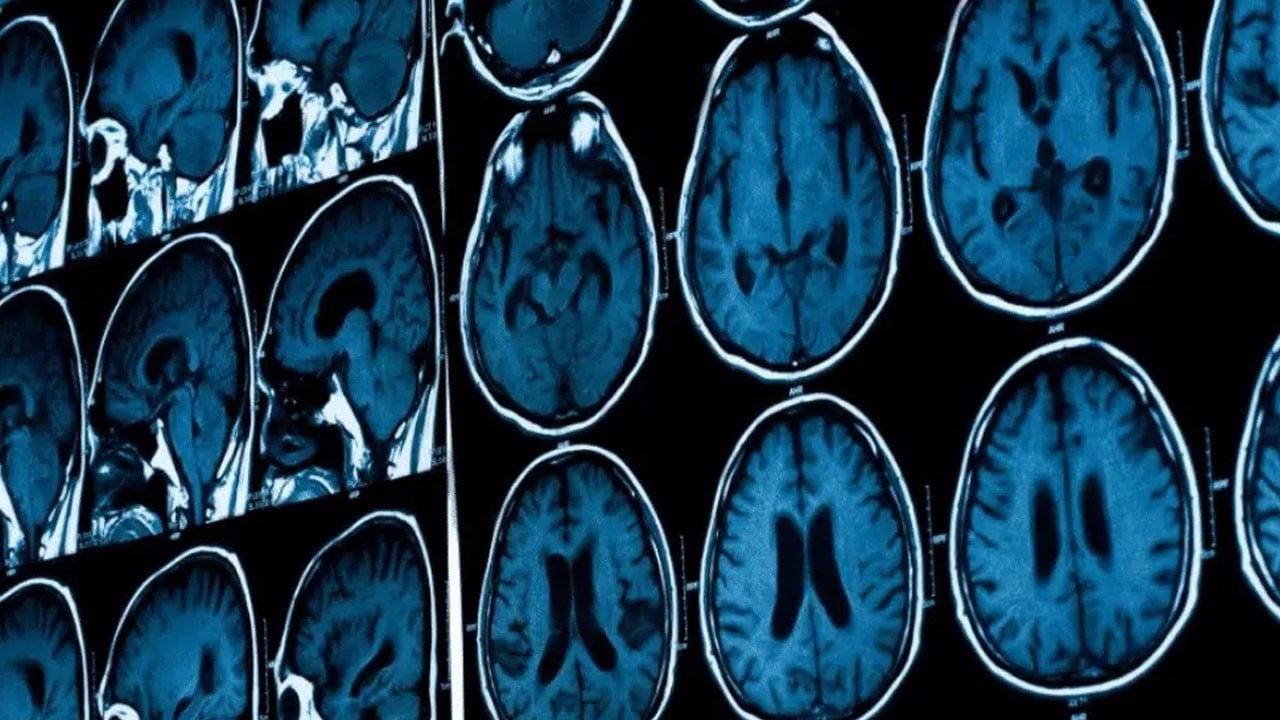 Migren öldürür mü?