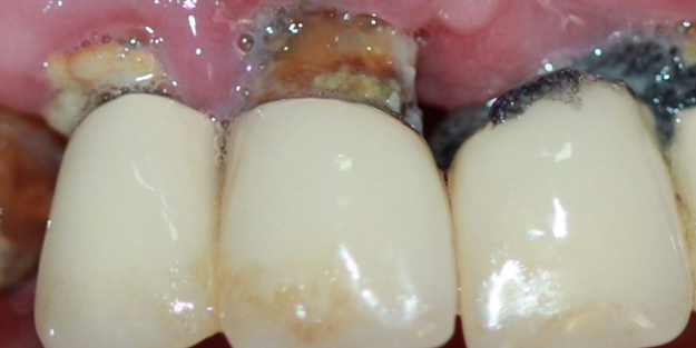 Milyonlarca insanın ölmesine neden olan hastalık! Dikkat çeken yeni paylaşım: Nelere dikkat edilmeli? Hekim duyurdu