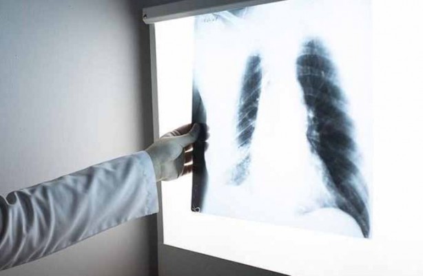 Milyonlarca kişi her an ölebilir! Uzman isim Türkiye'ye duyurdu: ölümle karşı karşıya, tüberküloz yeniden hortladı!