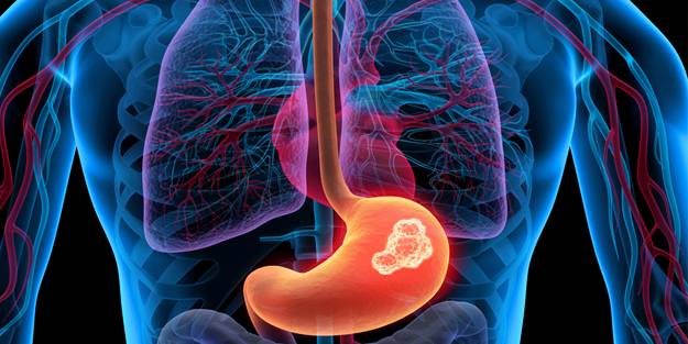 Mini By-pass nasıl yapılır?