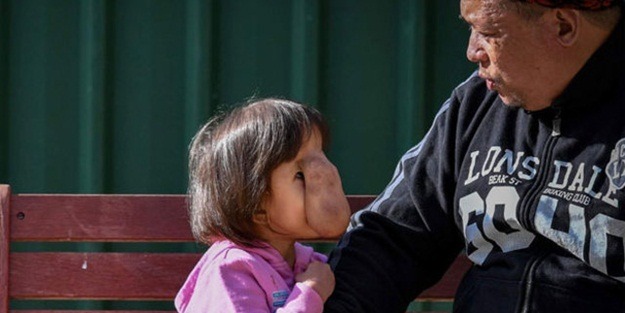 Minik Angel artık gülümseyebiliyor!