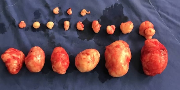 Miyom nedir? Miyom belirtileri nelerdir?