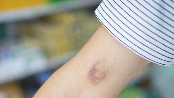 Morluklardan hızlıca kurtulmak mümkün mü?