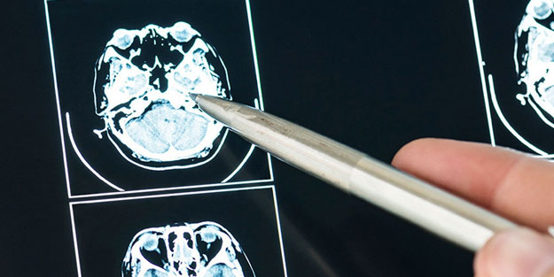 MS hastalığına neler yol açıyor? İşte MS hastalığının belirtileri...