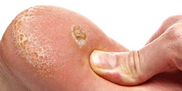 Nasır nasıl tedavi edilir?