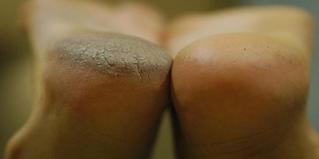 Nasır nedir? Nasıl geçer?