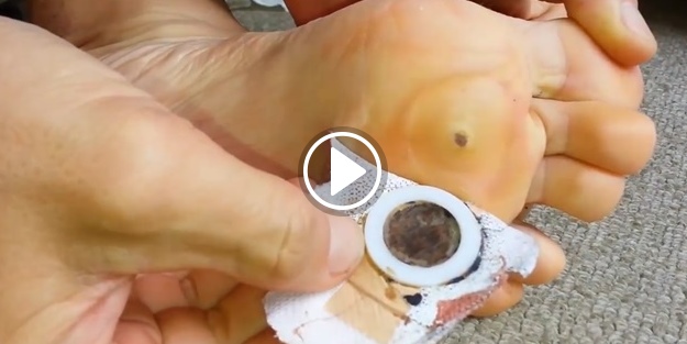 Nasır ve siğilden ilaçsız kurtulmak mümkün