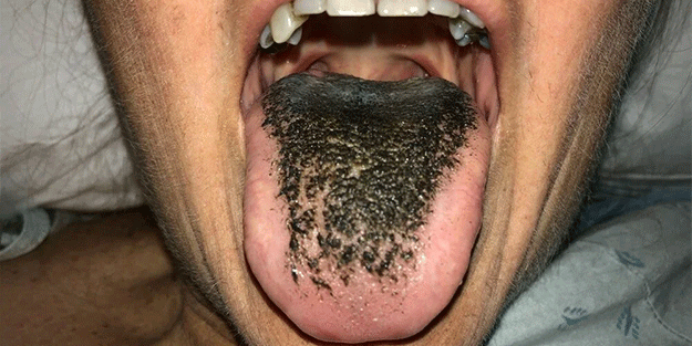 Ne olduğu duyunca şaşkına döneceksiniz Antibiyotik dilini bu hale getirdi