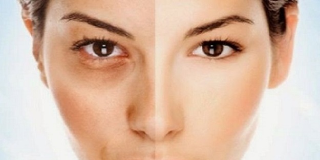 Neden göz altında morluk olur?