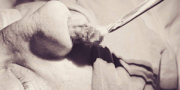 Hastanın burnundan çıkan şoke etti!