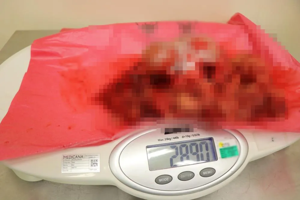 Nefes bile alamıyordu! Genç kadının karnından bundan tam 3 kilo çıktı