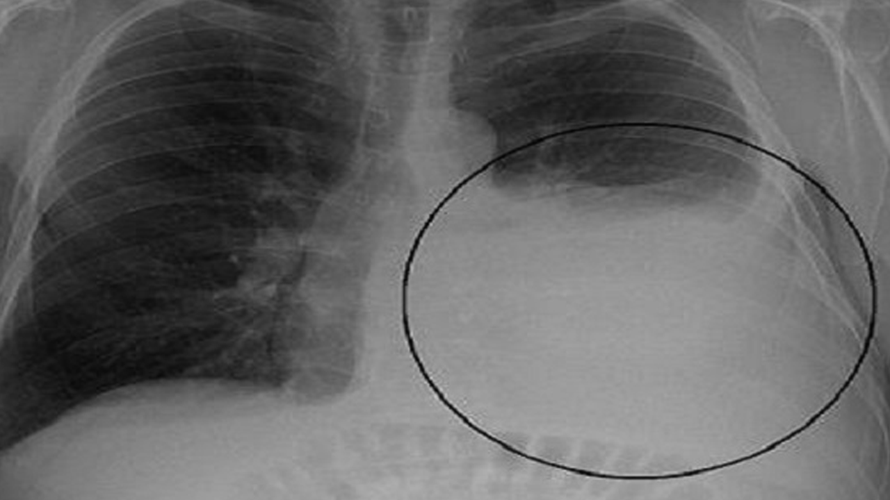 Nefes darlığı sanmayın: Bu sıvı akciğerinizi sıkıştırıyor olabilir!