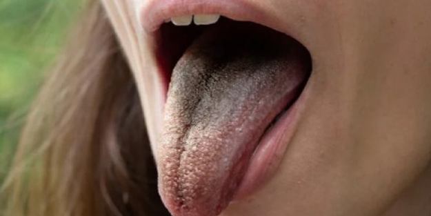 New York Times haberi gazetesinde yayınlandı! Covid boğaz ağrısı: İşte Covid-19’un olağandışı 5 belirtisi