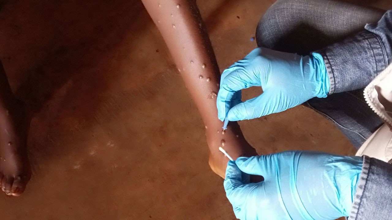 Nijerya'da M çiçeği vaka sayısı artıyor