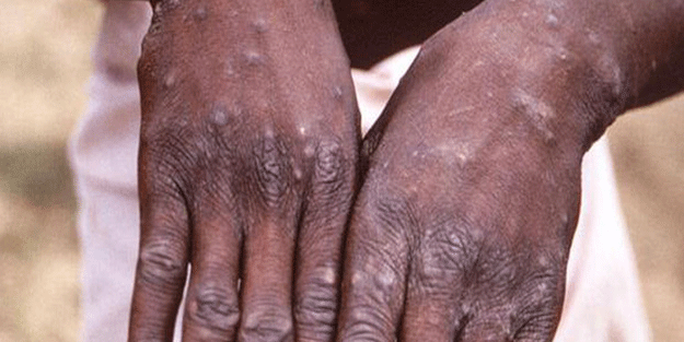 Nijerya'da maymun çiçeği vakası 32'ye yükseldi